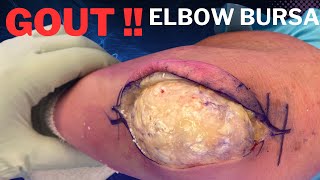 Elbow Olecranon Bursitis Gout Treated in 3 minutes [upl. by Hutton]