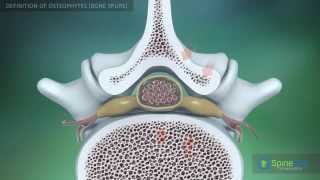 Osteophytes bone spurs Definition [upl. by Harobed]