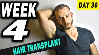 FUE Hair Transplant 1 Month post op Istanbul Turkey [upl. by Marva939]