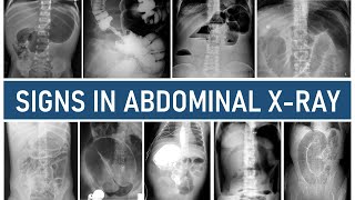 Signs in Abdominal Xray [upl. by Allie]