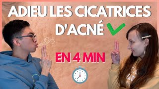 En finir avec les cicatrices d’acné en 4 minutes [upl. by Kilah]