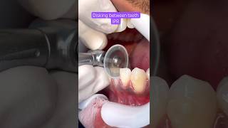 IPR BRACES Orthodontics Treatment [upl. by Ahsieit830]