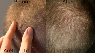 Removing a cerebriform nevus on the scalp using Plasma and Bonus Information at the End [upl. by Attenov]