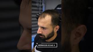 Hair Loss Types  Norwood Scale  Hair Transplant Turkey [upl. by Helmer]