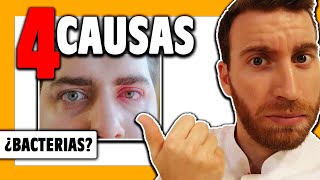 🟠 BLERARITIS ➡️ 4 Causas Cap 2 [upl. by Wilie]