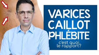 Varices caillot et phlébite cest quoi le rapport [upl. by Elac759]