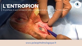 Chirurgie de lentropion Pole ophtalmologique [upl. by Milone713]