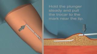 Jadelle insertion and removal Tutorial [upl. by Animsaj]