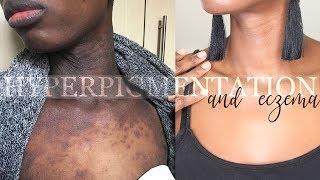 HEALING ECZEMA AND HYPERPIGMENTATION QampA WITH BEFORE AND AFTER [upl. by Griggs21]