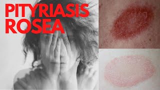 PITYRIASIS ROSEA  Answers of the common questions about Pityriasis Rosea What is Pityriasis rosea [upl. by Brittne]