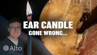 This Ear Candle Makes Hearing WORSE  Ear Wax Removal [upl. by Artemisia]