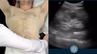 How to scan the kidneys using wireless ultrasound [upl. by Nabi]