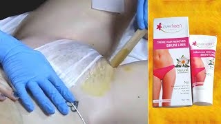 5 मिनट में प्राइवेट पार्ट के अनचाहे बाल जड़ से हटाइये Remove Unwanted Hair Bikini Line Hair Removal [upl. by Cheke]