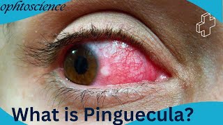 what is pinguecula symptoms sign treatment preventions [upl. by Given237]