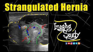 Strangulated Umbilical Hernia with Abscess Formation  Ultrasound  Doppler  Case 199 [upl. by Rogovy]