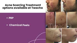 Acne Scarring Treatment l Acne Scars l Acne Marks l Dark Spots l Skin Clinic l Twacha l Dwarka [upl. by Shaffert]