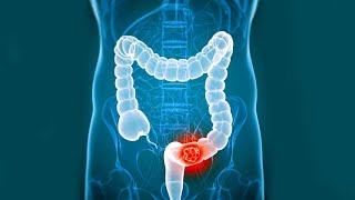 colon cancer  colorectal cancer  colon and rectal cancer [upl. by Jorge]