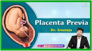 Placenta Previa Etiology Pathophysiology Clinical presentation Diagnosis and Treatment [upl. by Ariayek]