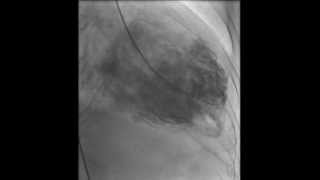 HAKIMVISTA MIOCARDIOPATIA DILATADA VENTRICULOGRAMA CON TROMBO INTRAVENTRICULAR [upl. by Inalan78]