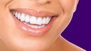 184 Teeth whitening Procedure Carbamide Peroxide [upl. by Ueih]