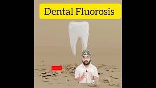 Dental Fluorosisक्या हैFluoride teeth treatmentytytshorts shorts dentalclinicdentist in Patna [upl. by Fried262]