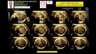 Shortlimbs Dwarfisme  Acromelia  Facial Dysmorphism [upl. by Surat718]