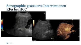 Sonographischgeführte Radiofrequenzablation RFA [upl. by Virgel]