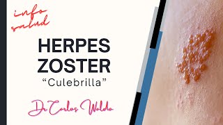 HERPES ZOSTER culebrilla [upl. by Urd]