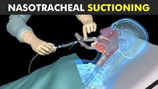 How Nasotracheal Suctioning Is Performed [upl. by Tenn271]