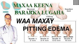 PITTING EDEMA  MAXAA KEENA BARARKA LUGAHA SIDA LOO DAAWEEYO [upl. by Herby488]