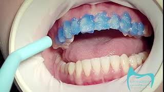 فينير فلدسباثك بدون حف اسنان Feldspathic veneers without teeth grinding [upl. by Navonod507]