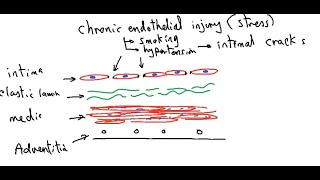 Systemic pathology 10  CVS  atherosclerosis  DRSAMEH GHAZY [upl. by Aisylla]