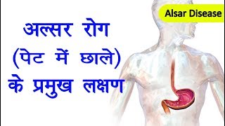 अल्सर के लक्षण  alsar ke Lakshan  alsar symptoms  ulcers rog ke lakshan [upl. by Pillihp]