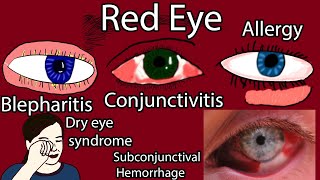 Red Eye Causes Symptoms and Treatment Pink eye causes [upl. by Binette]