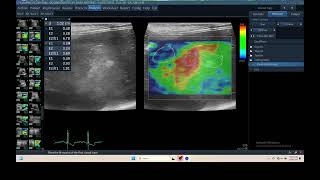 IQ 306 LIVER HEPATOMA ULTRASOUND ECHOPAC ANALYSIS ELASTOGRAPHY 2 [upl. by Fosdick164]