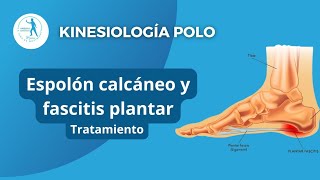 Espolón calcáneo y Fascitis plantar — Tratamiento [upl. by Sturges83]