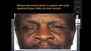 Approach to patient with diplopia [upl. by Cathrine]