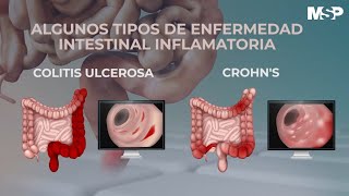 ¿Cómo tratar las enfermedades inflamatorias del intestino  ExclusivoMSP [upl. by Albrecht]