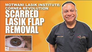 Scarring in LASIK flap treated by removal of LASIK flap [upl. by Druci345]