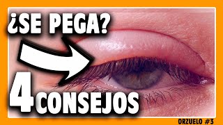 🔶 ¿El ORZUELO es CONTAGIOSO Sigue estos consejos [upl. by Lynsey975]