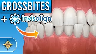 Can Invisalign Fix Crossbites [upl. by Kcinemod]