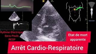 Arrêt CardioRespiratoire Échographie [upl. by Saint264]