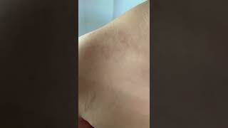 Pityriasis Rosea  Sanjeevani Skin Clinic India [upl. by Nnylg]