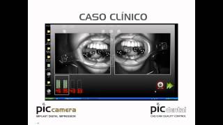 Implant Digital Impression amp Inmediated loaded [upl. by Gnehp619]