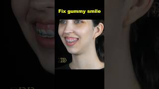 Fix gummy smile with braces braces orthodontist smile dentist [upl. by Malley52]