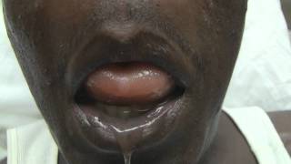 ACE Inhibitor Tongue Angioedema Emergency [upl. by Ciardap]