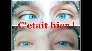 Lendemain doperation du strabismeTOUT VA BIEN strabismus operation [upl. by Lipkin]