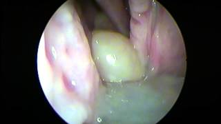 Left Antrochoanal polyp by Prof Dr Mohamed M ElSawy MD [upl. by Morgenthaler]