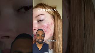 How does ACCUTANE work Dr Somji Explains [upl. by Galasyn]