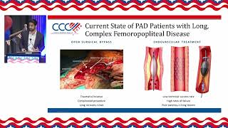 Raman Sharma MD Newer Interventional PTA Procedures and Renal Denervation [upl. by Knowlton]